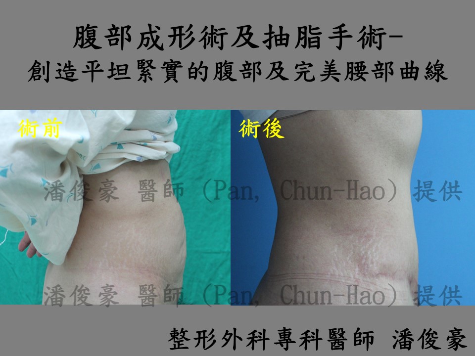 abdominoplasty wp 1