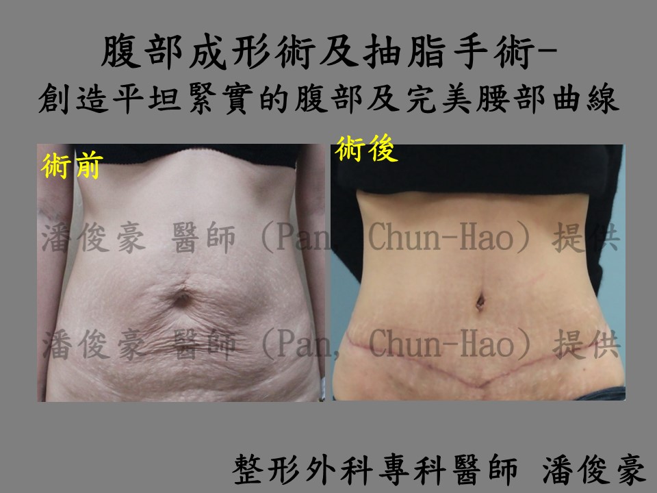 abdominoplasty wp2