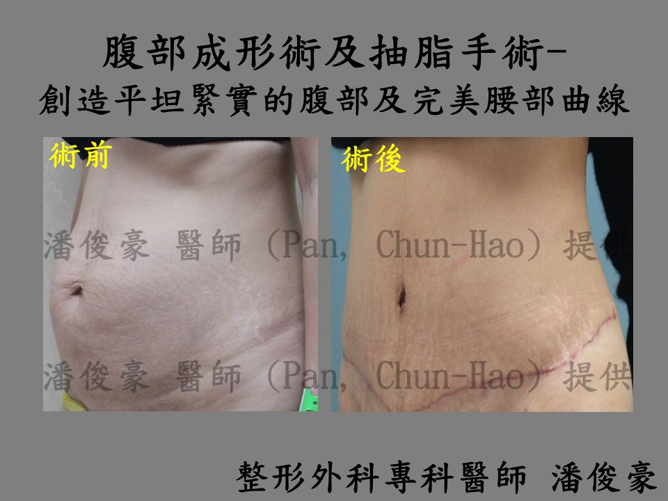 abdominoplasty wp3