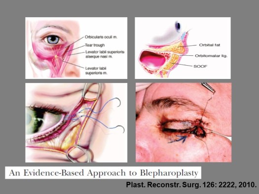 Blepharoplasty wp