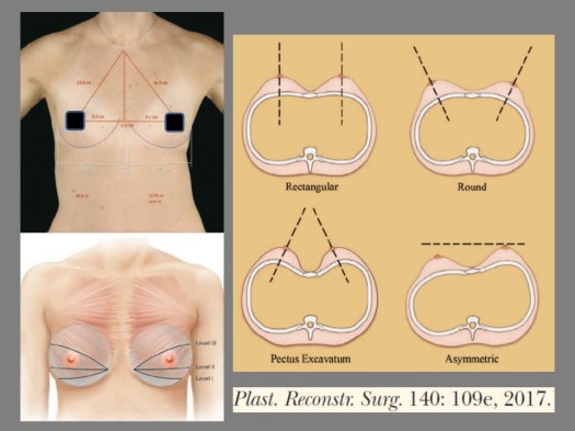 Breast Augmentation wp