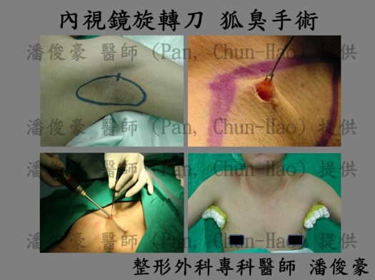內視鏡旋轉刀 狐臭手術 wp