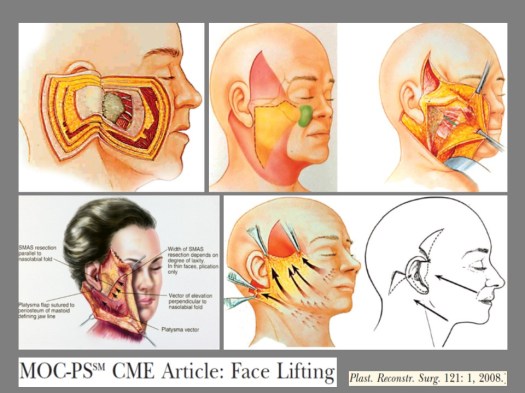Face Lift