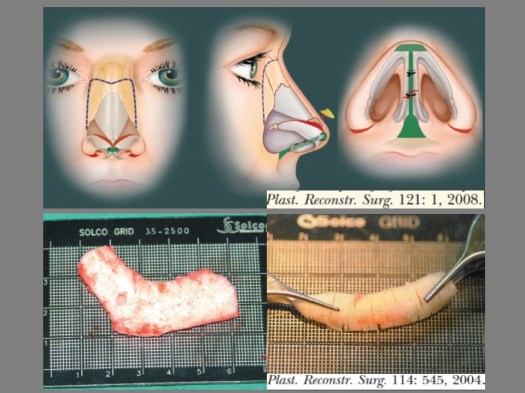 Rhinoplasty wp